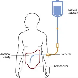 Dialysis 1