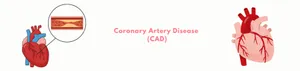 Coronary Artery Disease (CAD)