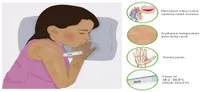 বাতজ্বরের লক্ষণ | Symptoms of Rheumatic Fever