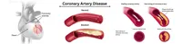 Coronary Artery Disease (CAD)