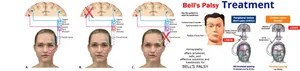 Bell's palsy