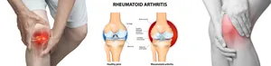 Rheumatoid Arthritis (RA)