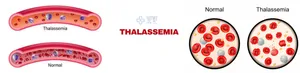 Thalassemia