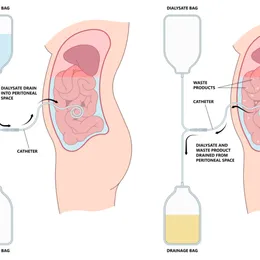 Dialysis 1